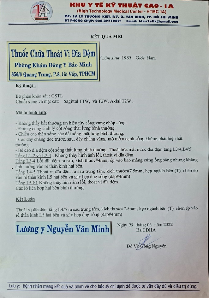 Thoát vị đĩa đệm